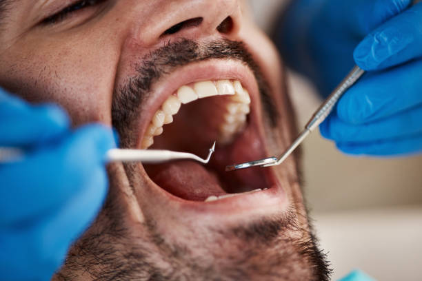 Best Emergency Dentist for Lost Fillings or Crowns in Maineville, OH