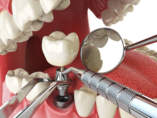 Best Broken or Cracked Tooth Emergency Dentist in Maineville, OH